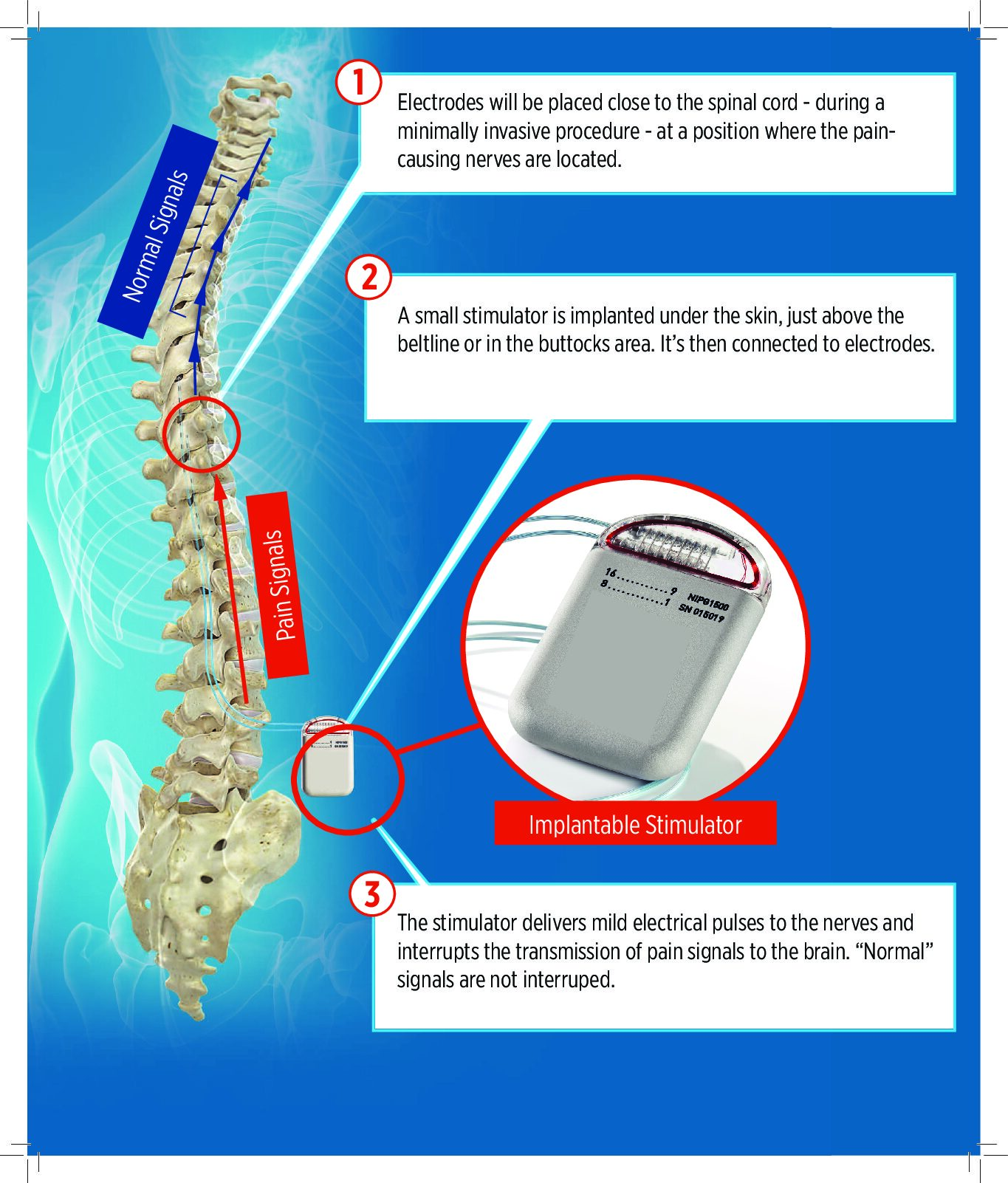 Spinal Cord Stimulation – Dr Thomas E Smith